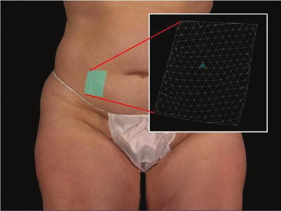 Three-dimensional Vectra (Canfield Scientific, Inc, Fairfield, New Jersey) photograph of tattooed treatment zones on a patient s abdomen.