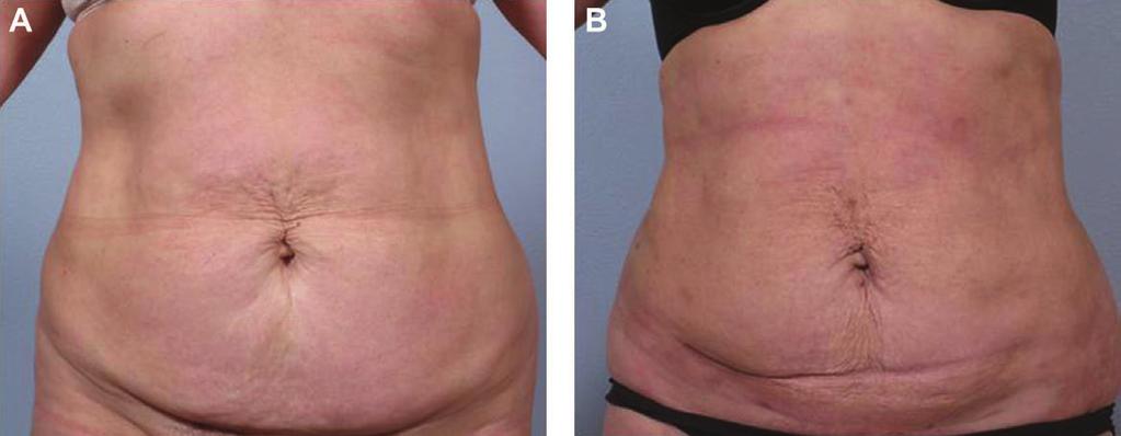 1160 Aesthetic Surgery Journal 33(8) Figure 8. (A) This 53-year old woman presented with a complaint of a loose, flaccid abdomen with excess fat and a suprapubic overhang.
