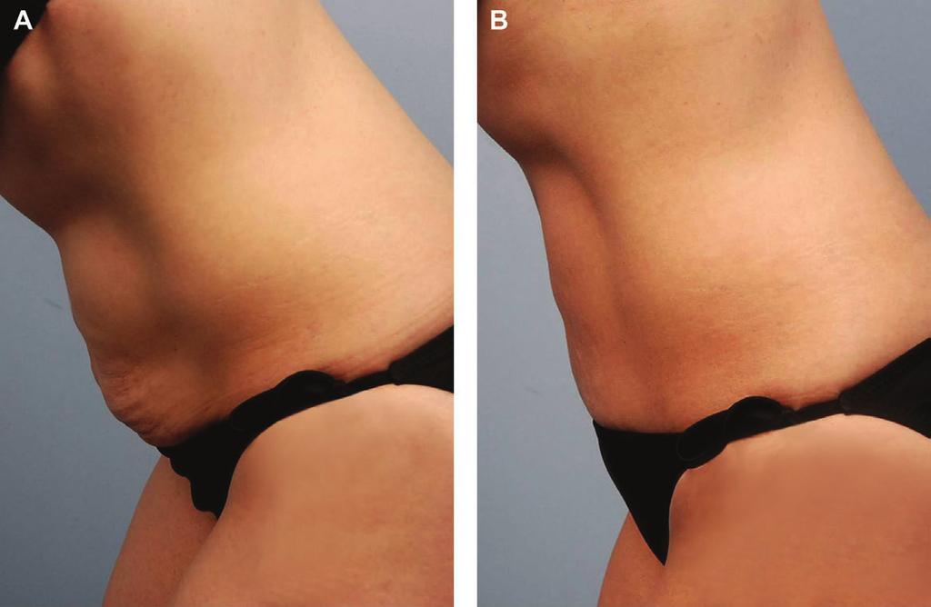 (B) Six weeks after treatment on the right side with suction-assisted liposuction (SAL) alone and on the left side with radiofrequency-assisted liposuction plus SAL.