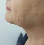 Skin Tightening Benefits In addition to achieving effective lipolysis, the thermal energy generated by the 1470 nm diode laser contracts existing collagen and elastin fibers and stimulates the