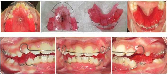 A removable Hybrid Functional Appliance (Twin Block with Lip Bumper and Expansion Screw) was choosen to stimulate the forward mandibular growth.