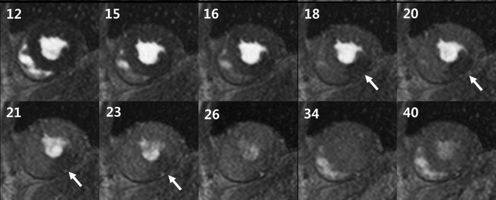 The cardiac adenosine stress perfusion MR imaging revealed two perfusion defects at the mid-anterior and mid-inferior walls (Fig. 1A, Movies A B A.