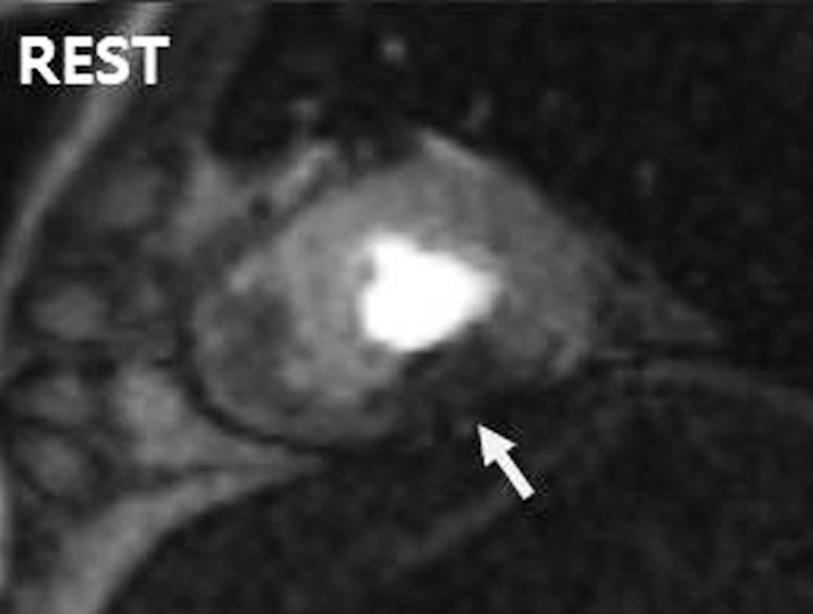 the presented case (4, 9). Su et al. (4) reported that upslope significantly increased from rest to stress in normal myocardium, whereas in ischemic myocardium the change was insignificant.