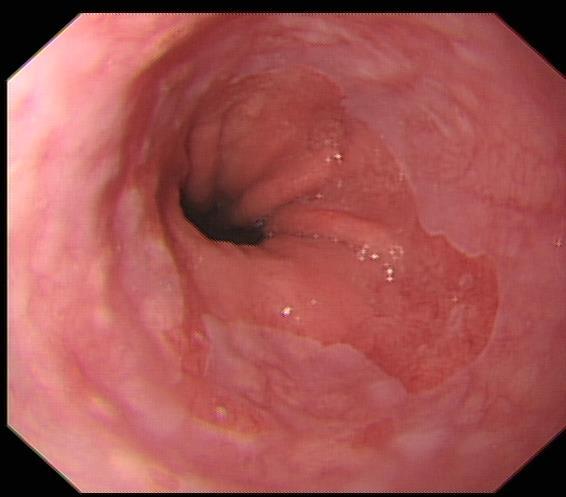 Diagnosing and reporting BO Is this Barrett s Oesophagus?
