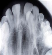 A unique treatment approach for maxillary canine-lateral in cisor trans-position. Am J Orthod Dentofac Orthop 2001;119:540-5. [15]. Payne GS.