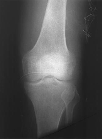 radiographs show the round or oblong gas shape