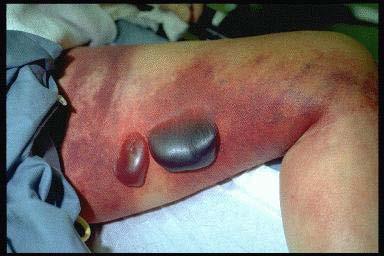 CLOSTRIDIAL MYONECROSIS Presentation Severe pain out of proportion to clinical findings