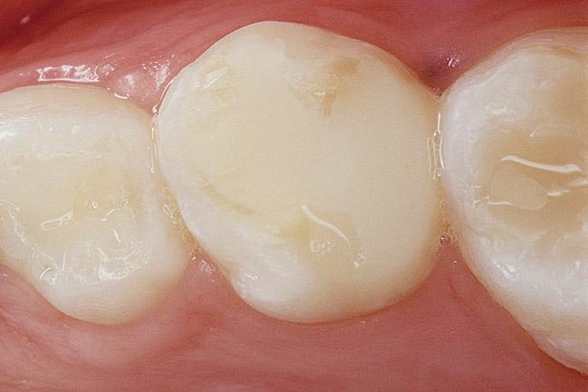 Composite An esthetic restorative material used in the place of amalgam.