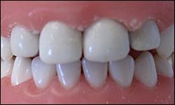 Zirconia Crowns Precision in preparation of tooth