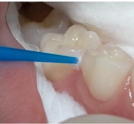 surrounding tooth structure and then restored with a synthetic plastic restorative