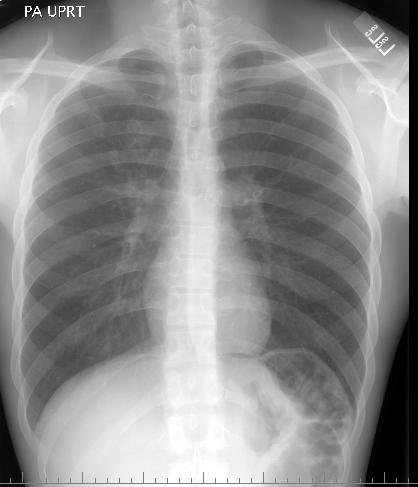 Stable chest x-ray consistent with old healed TB Children <4 years old Silicosis, Diabetes, ESRD, underweight, low dose