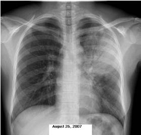 Initial Management of TB Suspect
