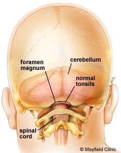 Normal cerebellar tonsils Cerebellar tonsils are pushed through the foramen magnum into the spinal