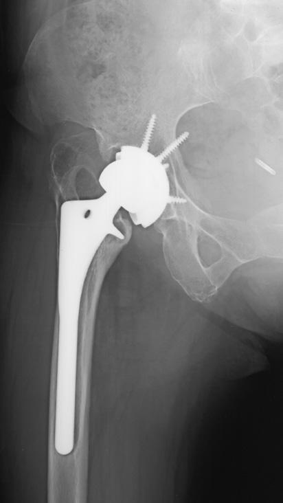 Extensively Porous-Coated Stems for Femoral Revision Chung et al and clinical records. Postoperative Harris Hip Score was 92.368 (range, 77-100).