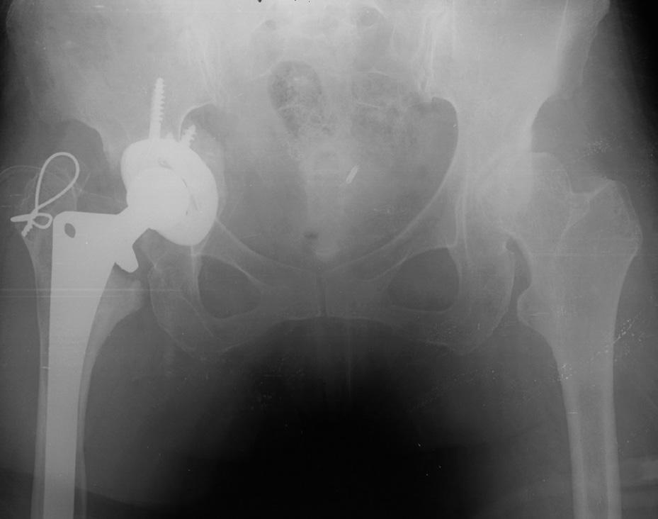 Figure 1: Anteroposterior radiograph showing liner wear with a Paprosky type III femoral defect in total hip arthroplasty.