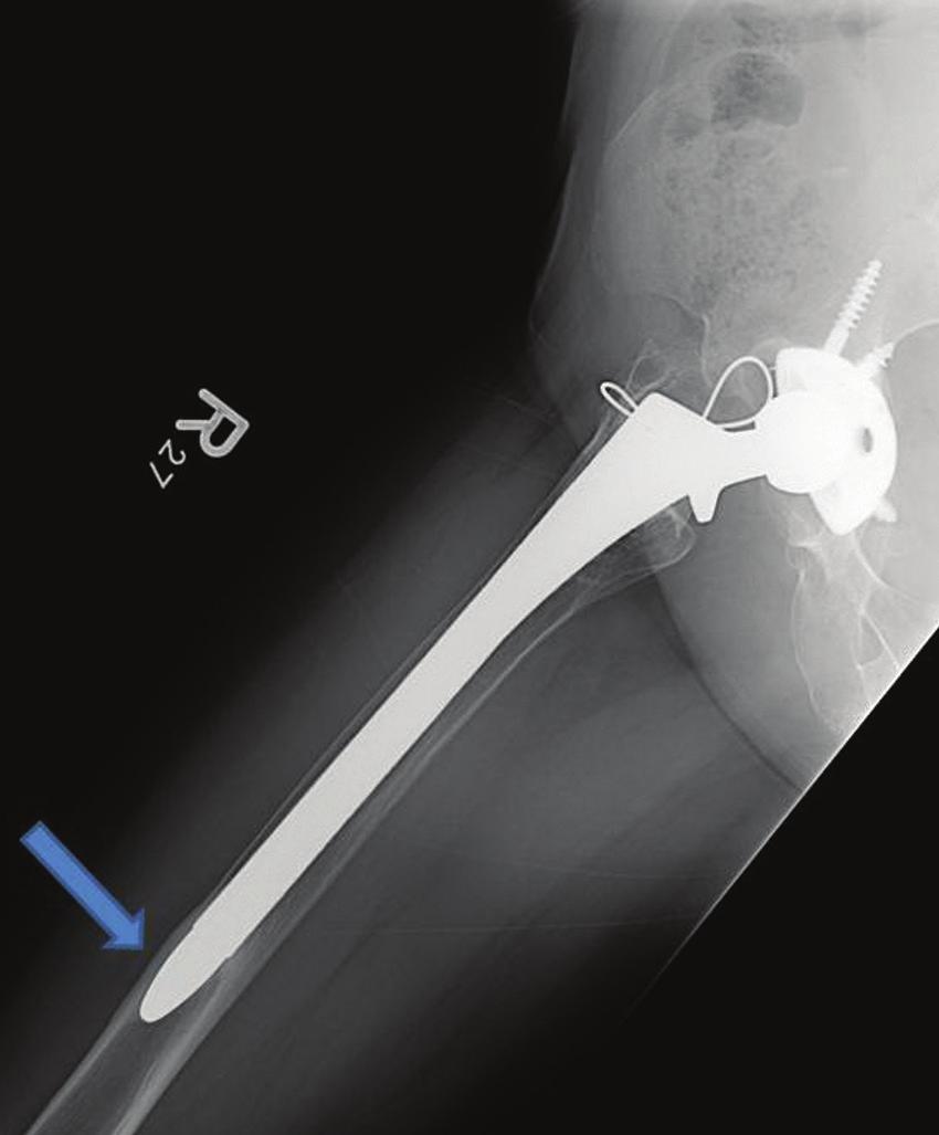 Discussion Femoral bone loss is a major challenge in revision THA. Extensively porouscoated stems are a reliable solution for femoral revision.