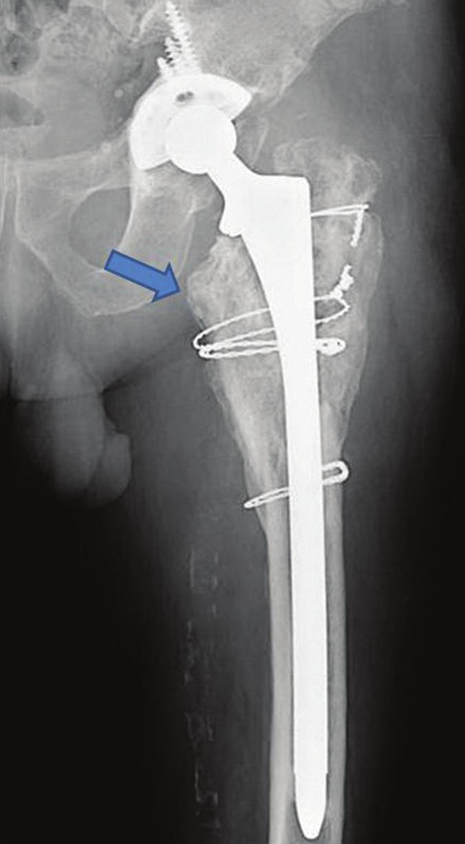 Figure 5: Anteroposterior radiograph showing loosening of the cemented stem with a Paprosky type III femoral defect in total hip arthroplasty.