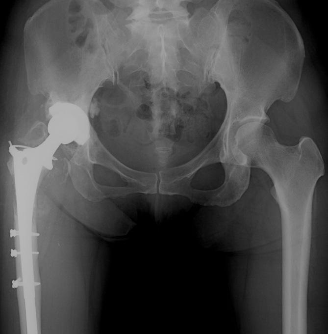 radiograph 8 years postoperatively showing union of the onlay bone graft over the medial aspect of the proximal femur.