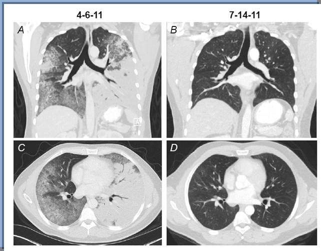 ROS1-translocated NSCLC (1.