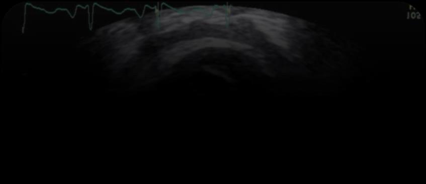 57 year old Female, retired CFO with Chest Pain,