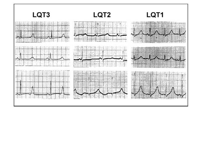 Distinctive T-Wave T Patterns in the 3 Major LQTS Genotypes J Am Coll Cardiol. 2008;51(24):2291-2300. doi:10.1016/j.jacc.2008.02.
