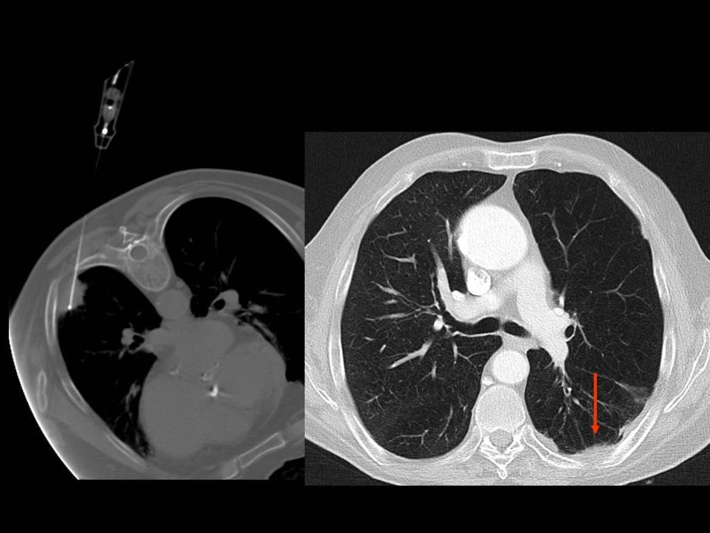 Fig. 5: CT scan obtained 18 months after the ablation shows mild