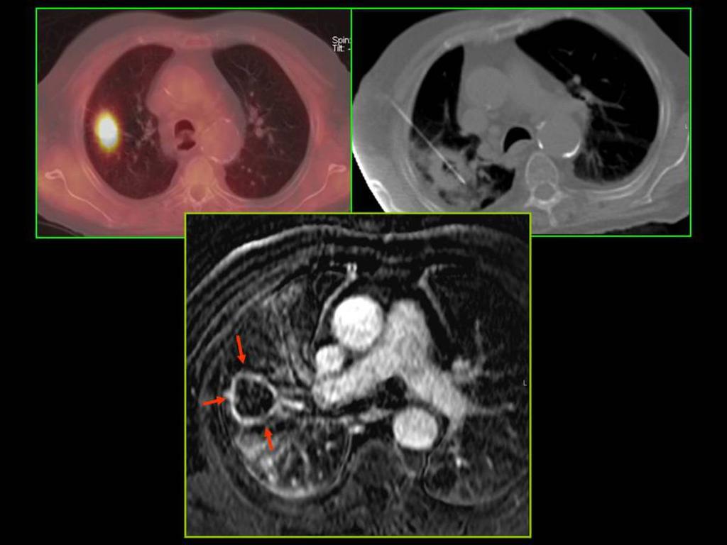 Fig. 6: Contrast-enhanced MRI with subtraction 8 months after the ablation.