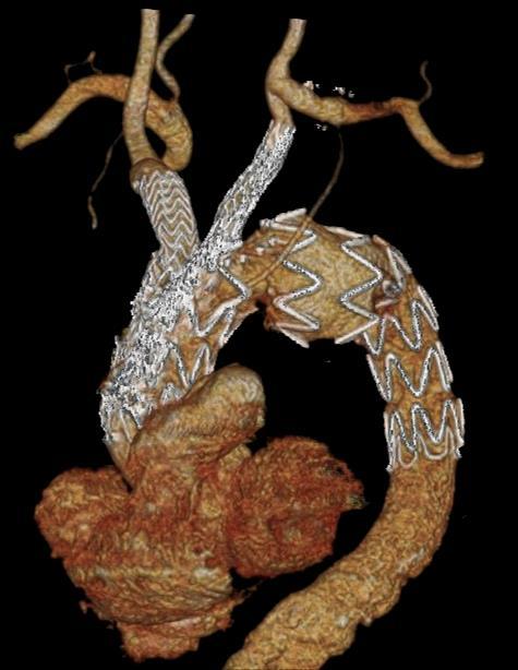 Conclusion (II) - Inner antegrade branched devices should be preferred for more extensive and fusiform aneurysms - Off-the-shelf single branch devices will be usefull in emergencies - Custom-made