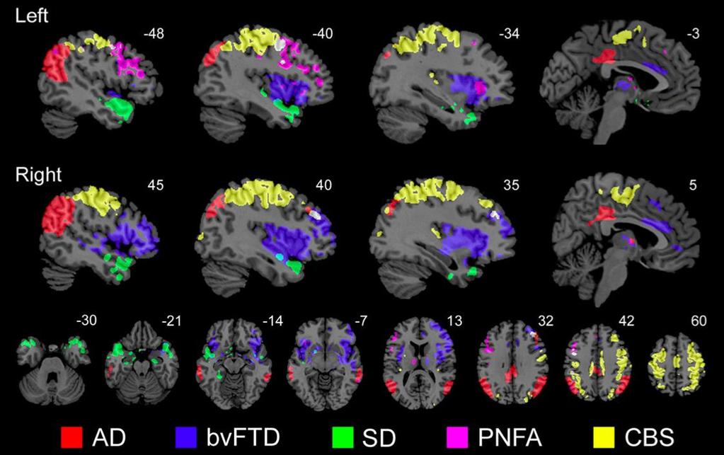 Brain Circuit Complexity: Neurodegenerative Disorders Target