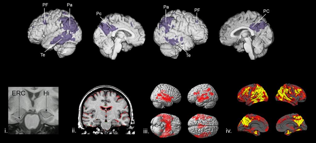 FDG PET & Volumetric MRI: Brain Imaging Biomarkers of
