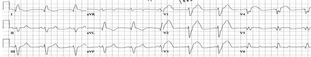 Second Degree AV block, 2:1 Not so easy could misdiagnose as NSR rate 64.