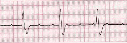 dropped QRS complexes 2 nd degree heart block, type II Complete