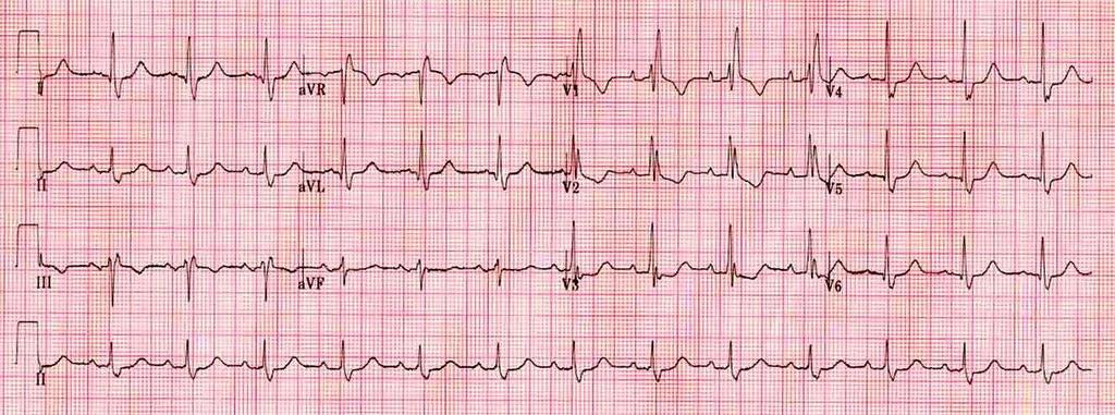 LBBB or