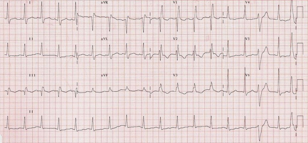 27 M BG: known antiphospholipid syndrome PC: pleuritic chest pain. Diagnosis?