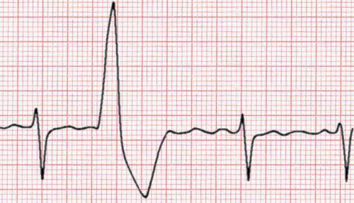 Wide based QRS