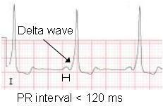 QRS, delta wave Digoxin