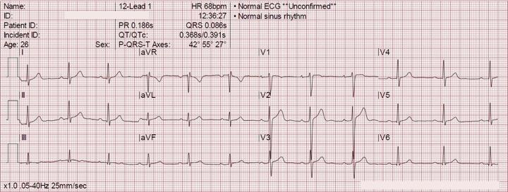 Presenting an ECG 1. What? When? Who? Where? Why? An electrocardiogram dated 15 th January 2018 at 10:30 of Joe Bloggs, 52 years old performed in A&E with a presenting complaint of chest pain 2.