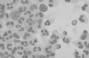 Meningitis - Haemophilus influenzae type B Antibody - polyribose phosphate capsule Allows efficient phagocytosis Development of conjugate vaccines: PRP - Diphtheria toxin Meningococcal OMP Sporadic