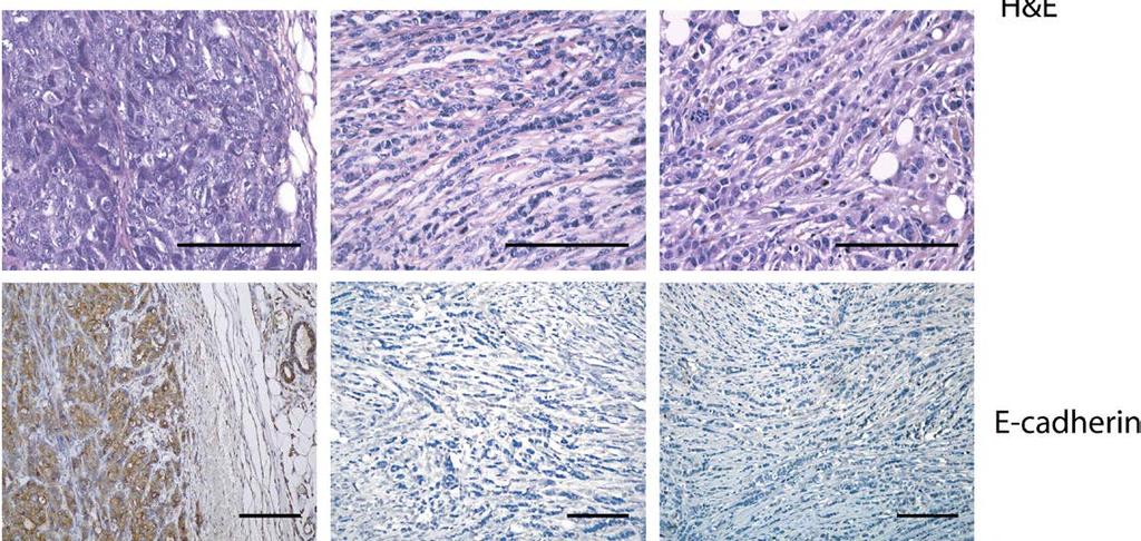E-cadherin inactivation & lobular carcinoma K14Cre;Trp53 F/F /Cdh1 F/F Introduced conditional E-cadherin mutations into mouse model based on epithelium-specific knockout of p53 Combined