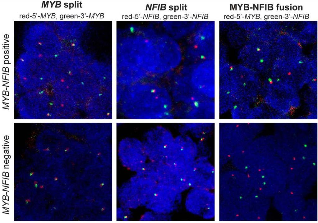 Breast adenoid cystic carcinomas harbour the MYB-NFIB fusion