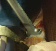 STEP 3 WEDGE INSERTION Insert the ALLOPURE Bicortical Cotton Wedge FIGURE 2 into osteotomy and impact until the