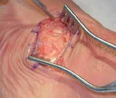 ALLOPURE Bicortical Allograft Wedge EVANS Procedure STEP 1 EXPOSURE / PREPARATION An oblique incision is made centered over the distal lateral calcaneus.