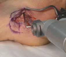Deepen the incision through the superficial facia, exposing the lateral surface of the calcaneus.