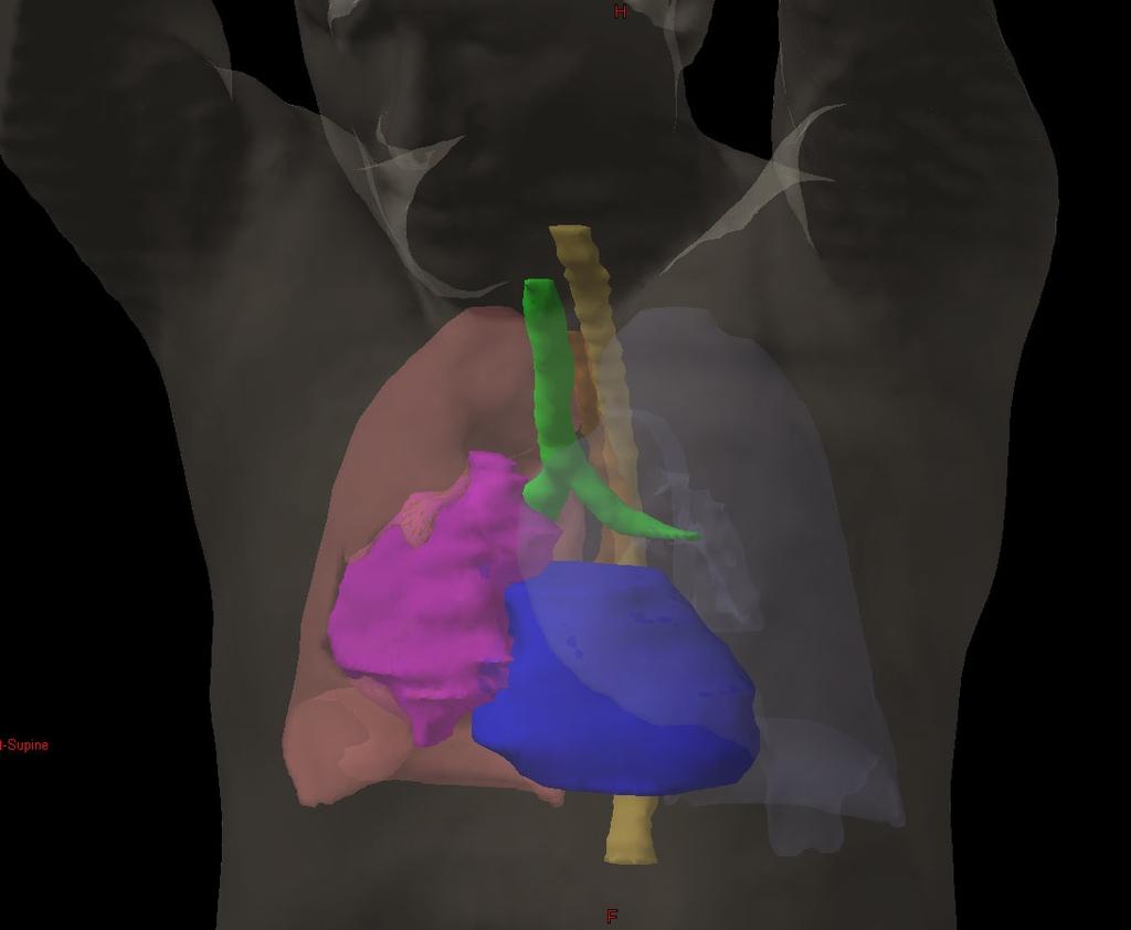 3D RECONSTRUCTION OF THYMOMA MASS & NORMAL OAR (Organs-at-Risk)---from Hung, Eng, Fuller, Scarbrough, &