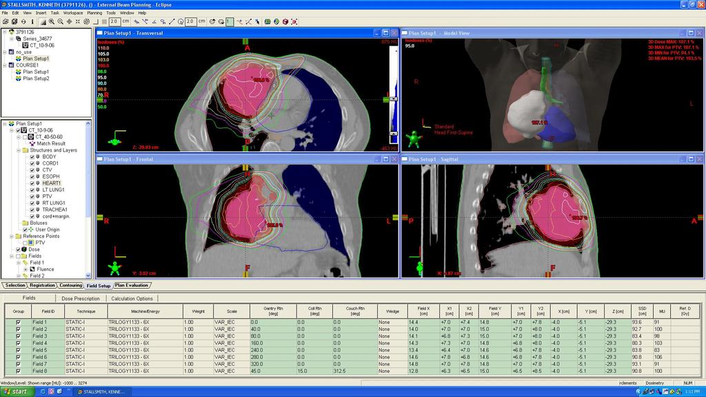 Isodoses from an IMRT plan for treatment of a large thymoma ---from Hung, Eng, Fuller, Scarbrough, &