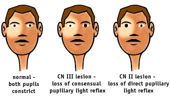 Purpose of testing: Pupillary light reflex can distinguish between damage to CN II (the optic nerve) and damage to CN III (the
