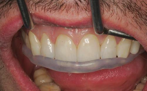 Ceramic veneers are one of the hottest topics in modern dentistry.