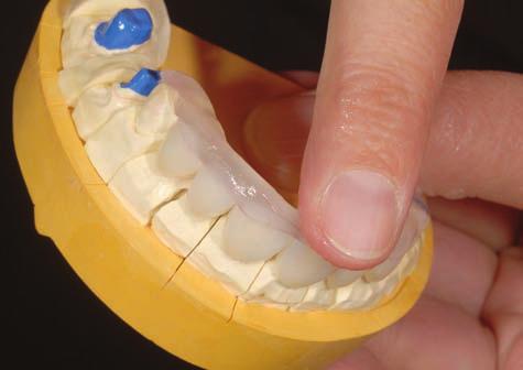 It is recommended that Primosplint be placed on the incisal; subsequently shape the mateials by tapping it lightly so that it will slide and will adhere in a precise and uniform way (Fig.