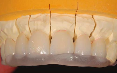Is the midline correct? Is the position of the veneers correct with respect to the vertical alignment of the teeth? Did we achieve the best possible cosmetic result?