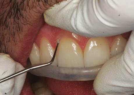 Once the work is in place it is possible to proceed with the cementation of the individual veneers. Usually we work from the back to front, therefore starting from the last veneer.